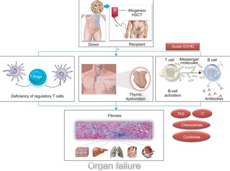 gcvhg|Pathophysiology of Chronic Graft.